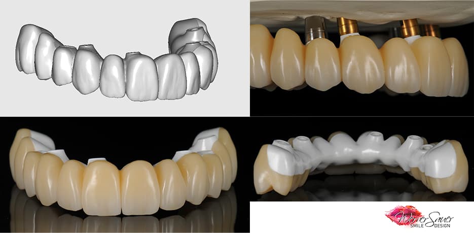 Rehabilitation of maxillary FP1 with advanced periodontitis, non